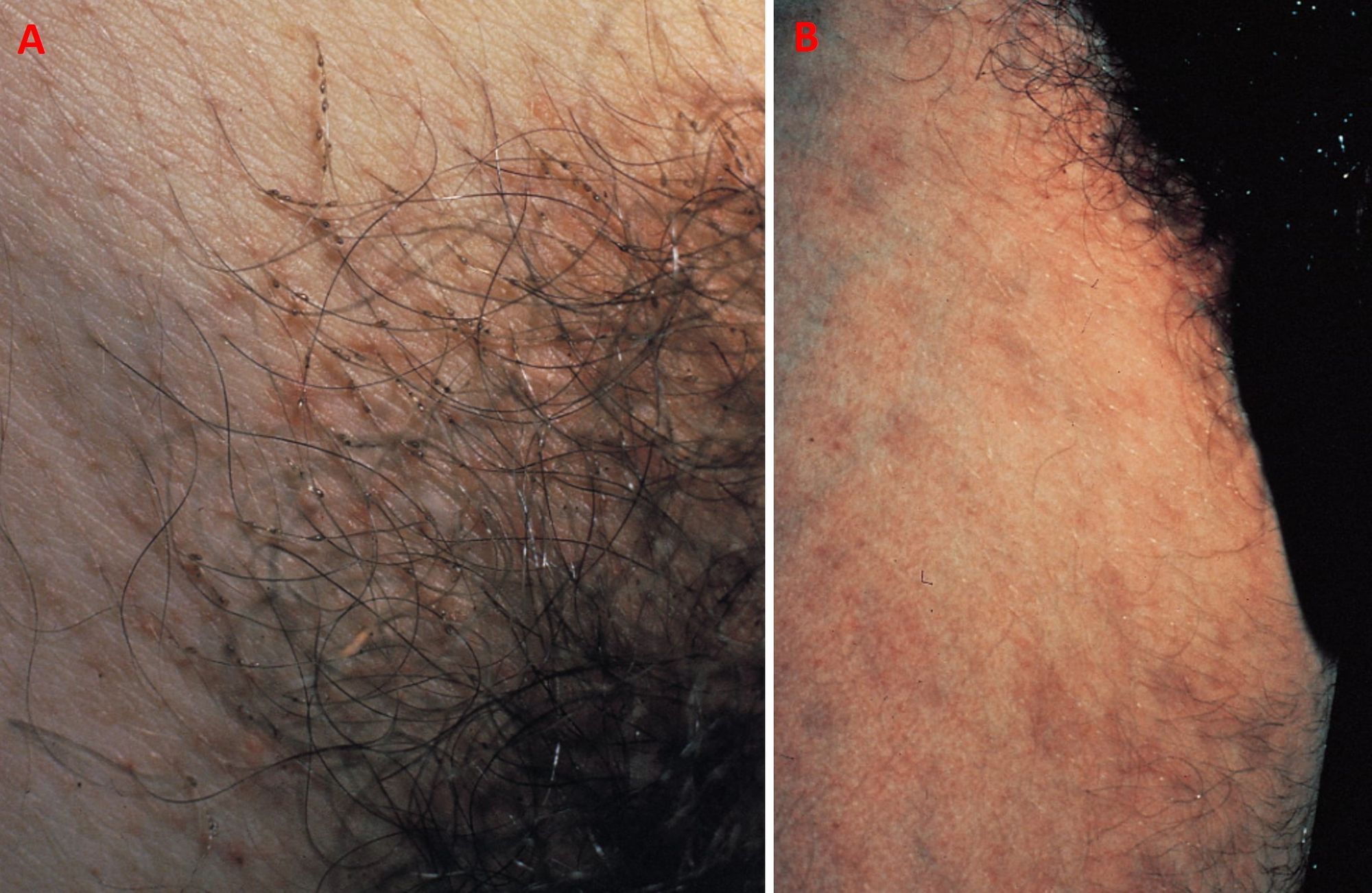 Infezioni sessualmente trasmissibili: diagnosi, terapia e profilassi