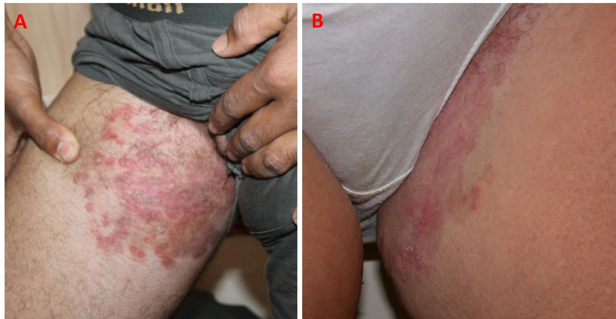 Infezioni sessualmente trasmissibili: diagnosi, terapia e profilassi