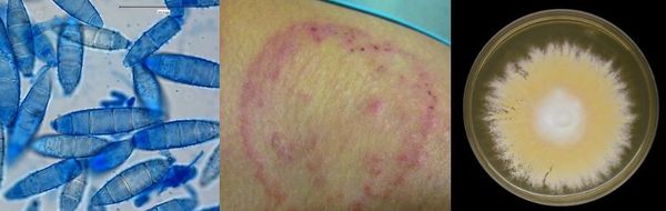Infezioni fungine della pelle? Ecco la guida completa