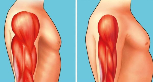 Distrofia muscolare di Duchenne